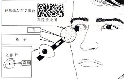 義眼適合什么樣的患者？