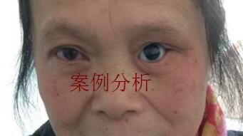 中老年人佩戴義眼片容易出現的幾種情況