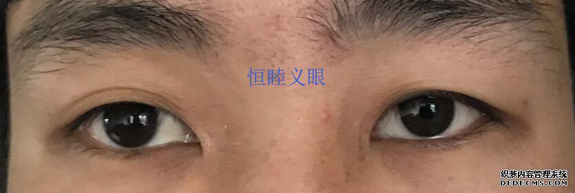 林先生佩戴更換義眼片，保留眼球，眼球萎縮