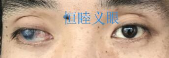 廢用性斜視，眼球突出通過義眼片改善吳先生外