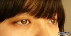 個(gè)性化義眼與傳統(tǒng)義眼、成品義眼之間的區(qū)別