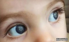 兒童安裝義眼相關(guān)問題解答